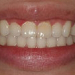 Giảm cân, giảm luôn bệnh nướu