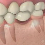 Biện pháp vệ sinh răng miệng cho bệnh nhân mang phục hình cố định