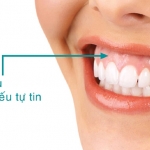 CƯỜI HỞ NƯỚU DO RĂNG CỬA HÀM TRÊN NGẮN