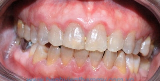 Răng sứ Emax Zircad - Ivoclar Vivadent 4