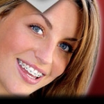 Một số điều nên biết về chỉnh hình răng