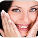 Bí quyết vệ sinh răng miệng khi nắn chỉnh răng