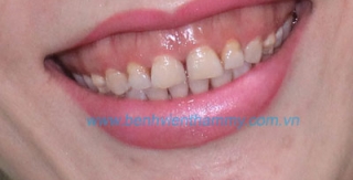 Răng sứ thẩm mỹ 10 răng Emax ZirCad