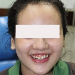 Cải thiện nụ cười với niềng răng.........! 01