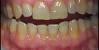 Răng nhiễm Tetracycline - Nguyên nhân và cách khắc phục 