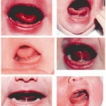 Dính thắng lưỡi ở trẻ em - Những điều cần biết - Phần 2