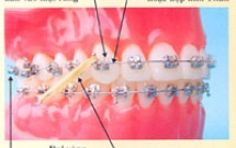 Phụ huynh và trẻ -Sự cần thiết trong điều trị chỉnh nha thành công