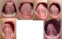 Dính thắng lưỡi ở trẻ em - những điều cần biết - Phần 1
