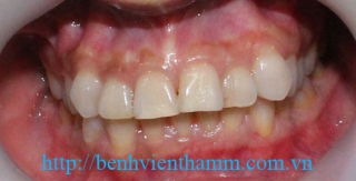 Răng sứ Emax Zircad - Ivoclar Vivadent 10