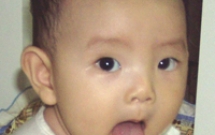 Ung thư lưỡi liên quan đến bệnh răng lợi mạn tính 