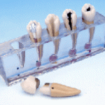 Mục đích của  chữa tủy răng