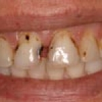 Chế độ ăn gây sâu răng