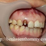 Răng sứ Emax Zircad - Ivoclar Vivadent - Thụy Sỹ 19