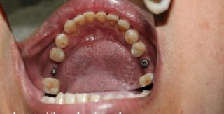 Cấy ghép implant 1