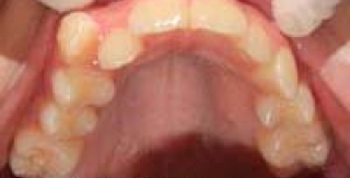 CHỈNH NHA HIỆN ĐẠI: HẠN CHẾ NHỔ RĂNG