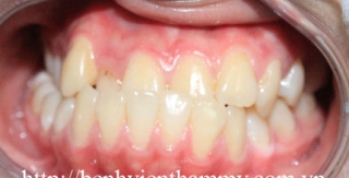 Chỉnh hình răng thẩm mỹ điều trị răng móm
