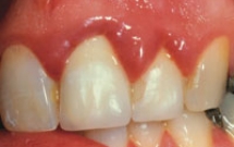  Viêm Sưng Nướu (Lợi) RăngTăng Cao Nguy Cơ Bệnh Tim Mạch