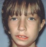 Tật nhỏ nửa mặt (Hemifacial microsomia)(Goldenhaar syndrome)