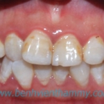 Răng sứ Ivoclar vivadent 12