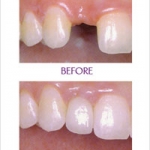 THỰC HIỆN PHỤC HÌNH TRỰC TIẾP TRÊN IMPLANT