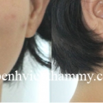 Chỉnh hình răng thẩm mỹ điều trị răng hô – cắn hở với mắc cài kim loại