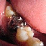 Mão kim loại - Bền chắc - Nhưng kém thẩm mỹ