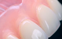 Dùng răng giả dễ bị hóc