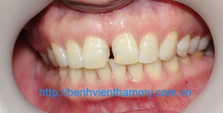 Răng sứ Emax Zircad - Ivoclar Vivadent 14