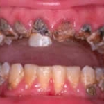 Mục đích của vệ sinh răng miệng