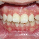 Chỉnh răng hô ở trẻ em