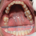 Phục hình implant 3 implant