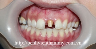 Răng sứ Ivoclar vivadent 17