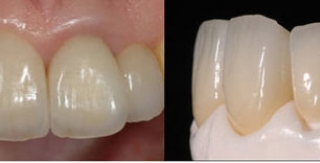 Răng sứ thẩm mỹ