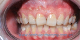 Răng sứ Cercon Smart - Denstfly 2