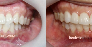Điều trị răng chen chúc với Răng sứ Veneer thẩm mỹ - kết hợp chỉnh hình răng tiền phục hình