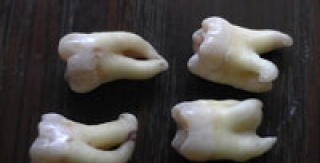 Đi nhổ răng suýt mất cả tay