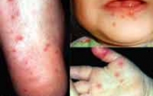 CHĂM SÓC TRẺ BỆNH TAY CHÂN MIỆNG 