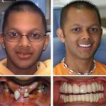 Khi nào nên cấy ghép implant? 
