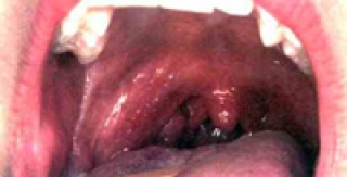 Ung thư vòm họng