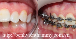 Chỉnh hình răng thẩm mỹ điều trị răng hô với mắc cài kim loại 2