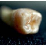 Răng sâu tự liền