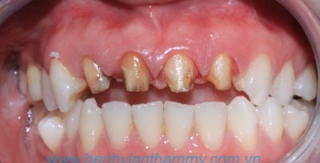 Răng sứ Emax Zircad - Ivoclar Vivadent 9