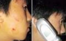 Giải mã dị ứng với nickel 