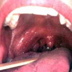 Ung thư vòm họng