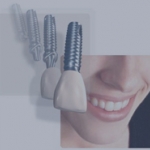 Có nên cấy ghép - implant răng?