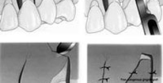 Các phương pháp điều trị co lợi