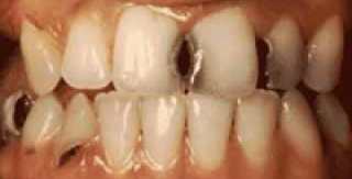 Răng sâu được chữa trị như thế nào? 