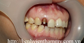 Răng sứ Emax Zircad - Ivoclar Vivadent - Thụy Sỹ 19