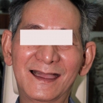 Nụ cười mới với Implant toàn hàm