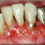 Các khối u ác tính vùng hàm mặt (Malignant tumor, oral cancer) 
